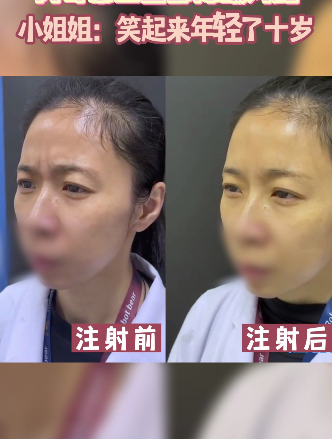 肉毒素上面部除皱对比!笑起来年轻十岁~