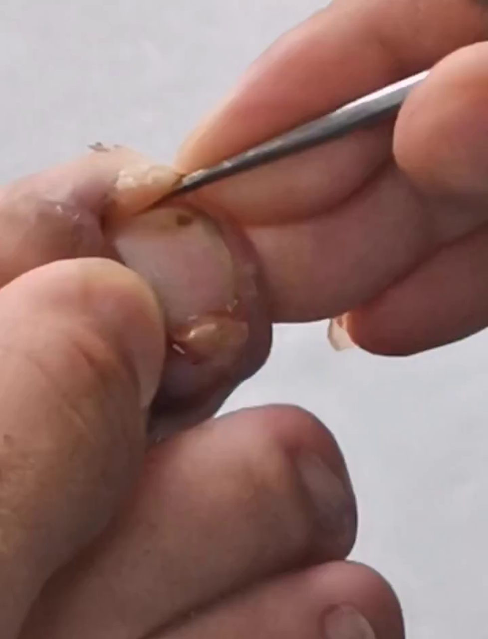 看这个视频学治嵌甲,用小工具轻轻清理指甲边的肉芽
