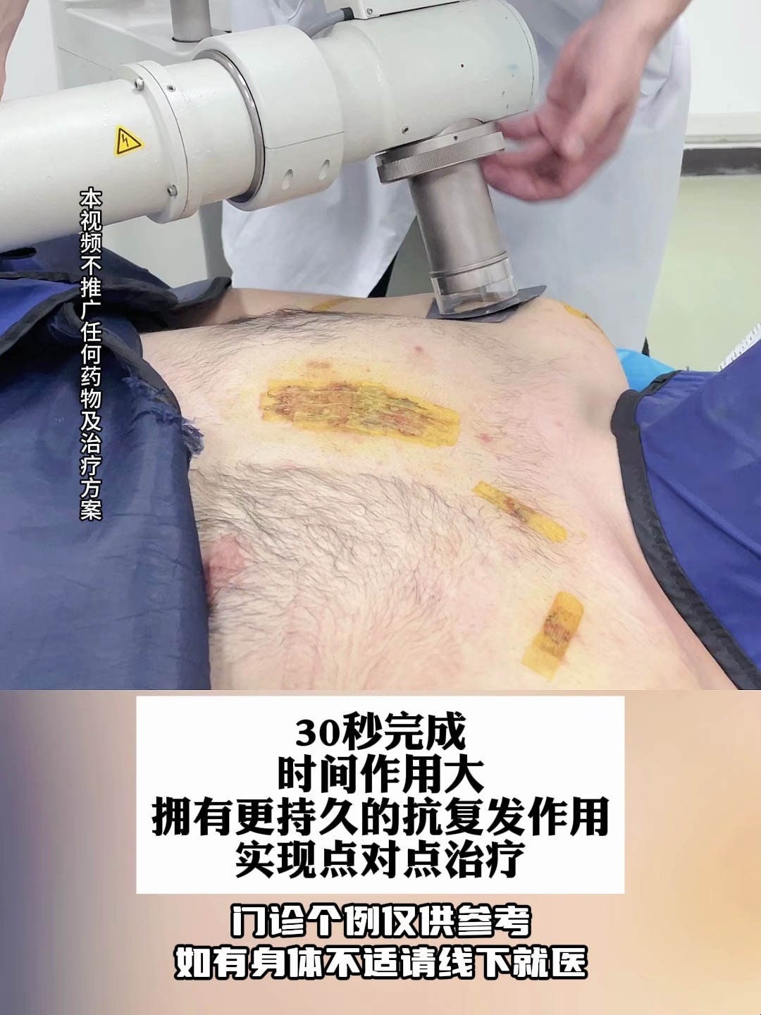 胸前长肉疙瘩,微创+浅放SRT100+综合管理