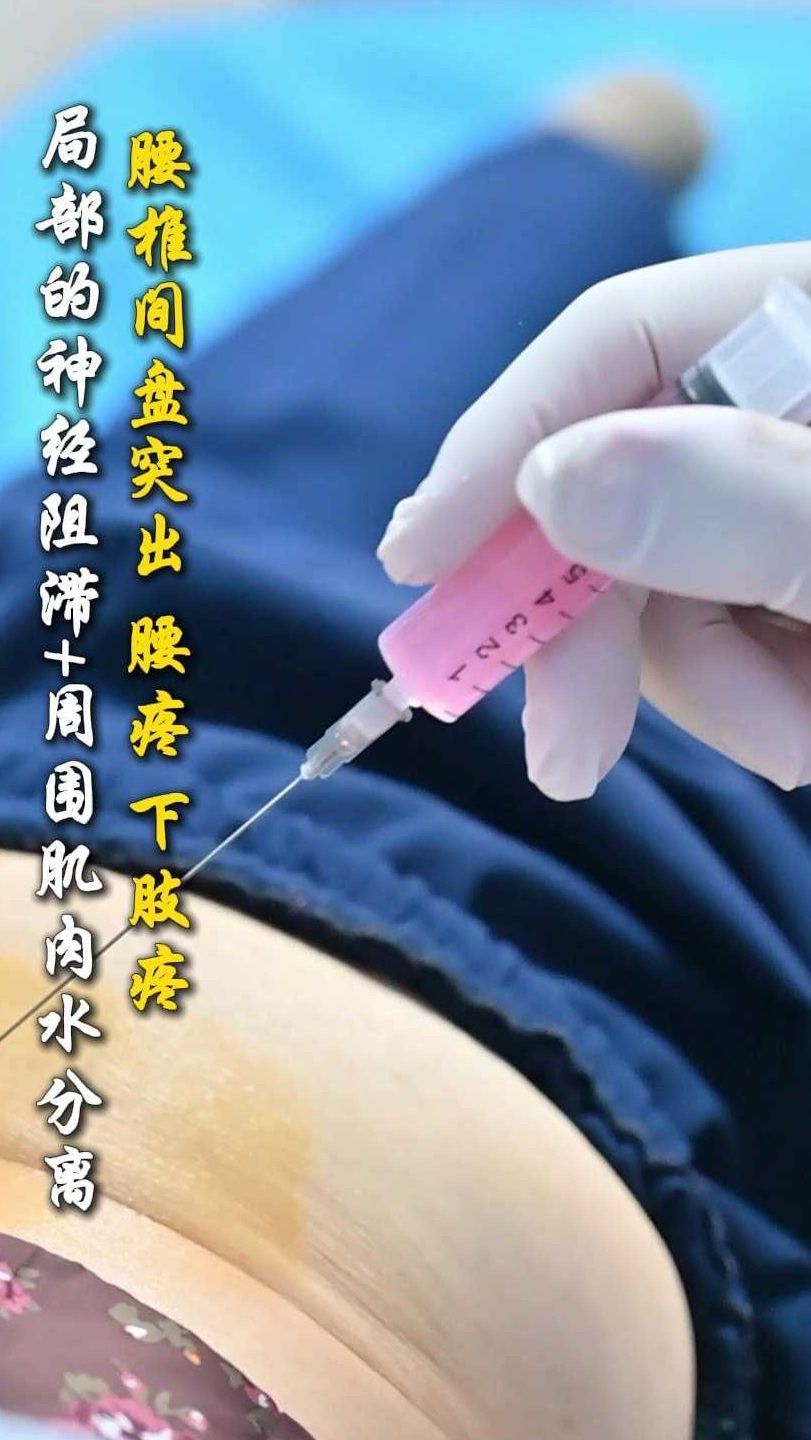 腰椎间盘突出 腰疼 下肢疼局部的神经阻滞+周围肌肉水分离