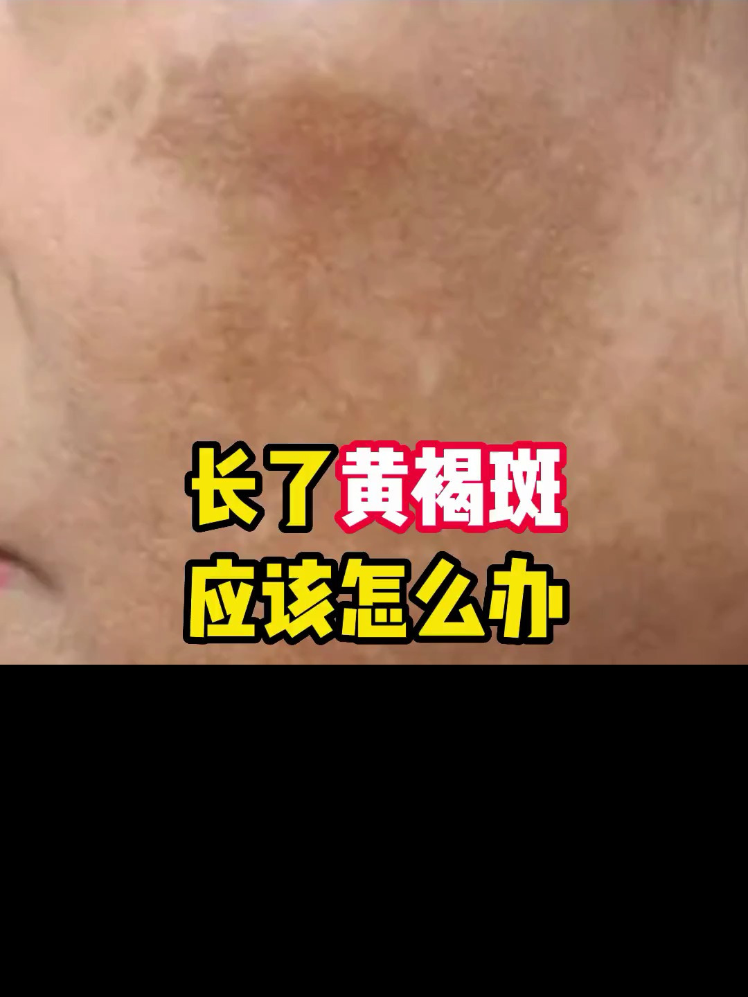 长了黄褐斑 应该怎么办?