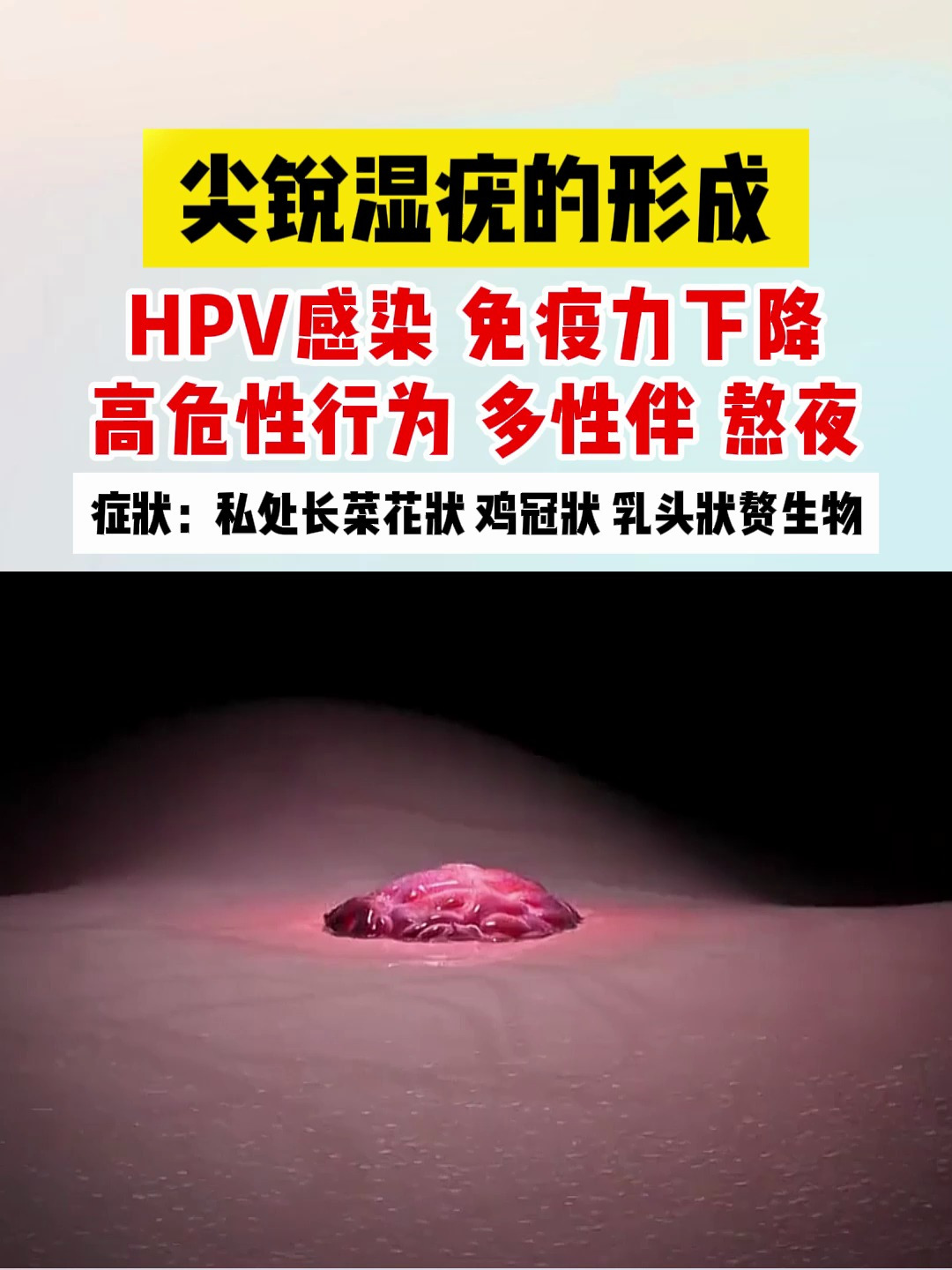 尖锐湿疣的形成 您也有这些问题吗