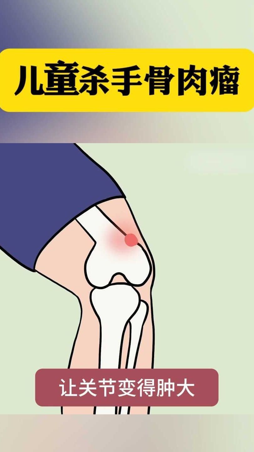儿童杀手骨肉瘤!