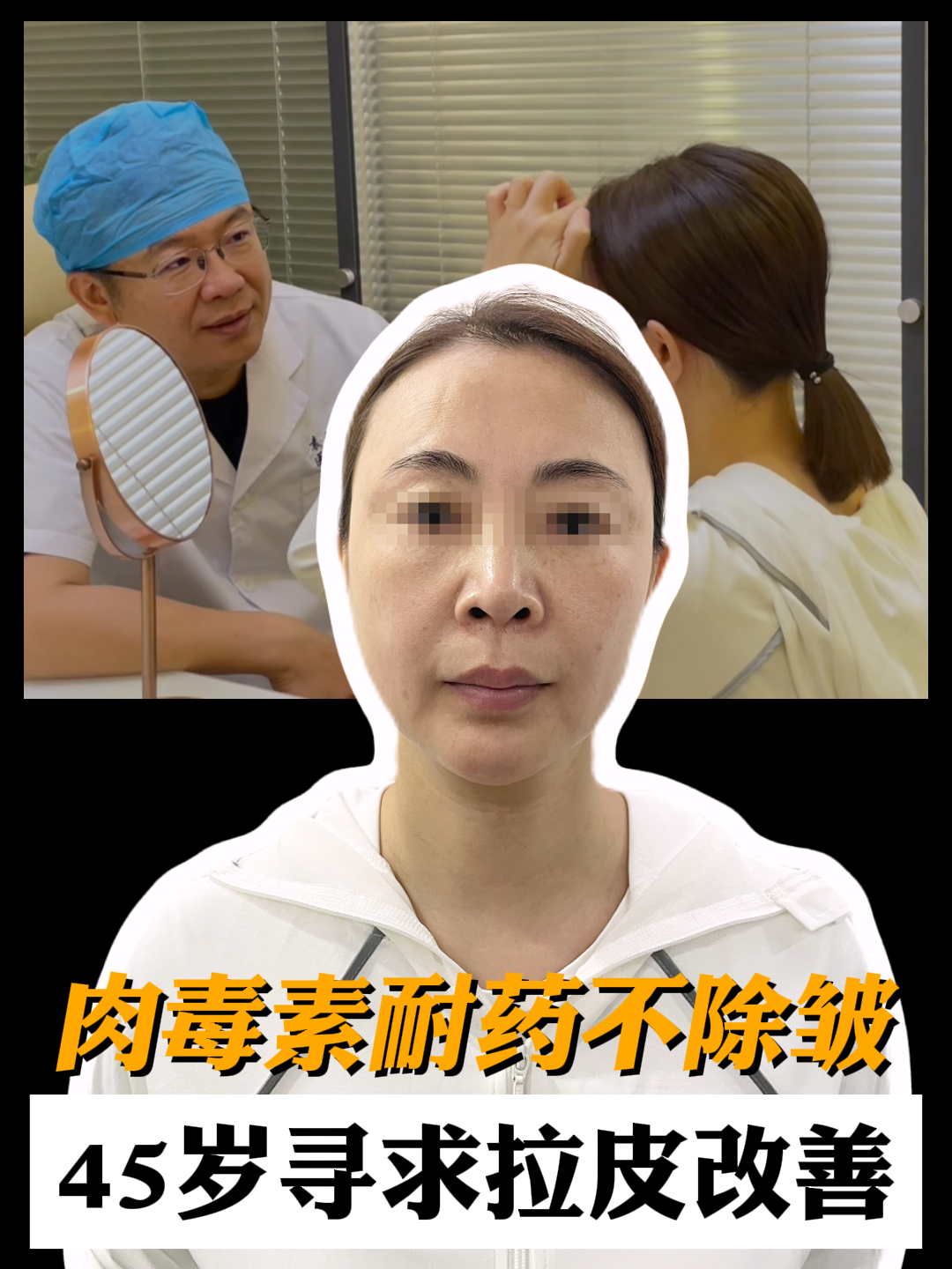 肉毒素耐药不除皱,急坏了!45岁姐姐寻求大拉皮改善