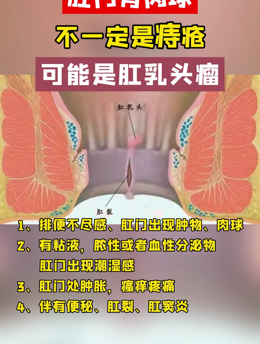 肛门口有肉球,不一定是痔疮!