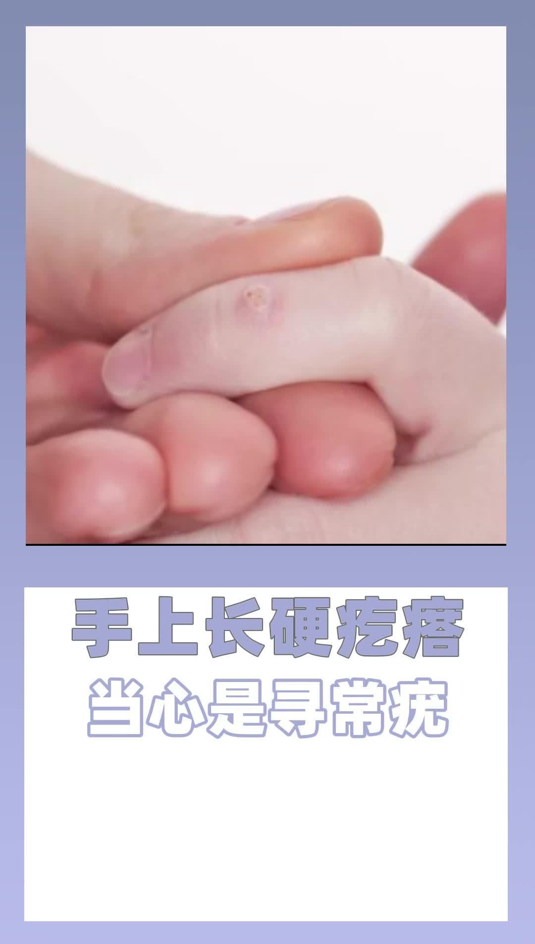 7.19 手上长硬疙瘩当心是寻常疣(1)