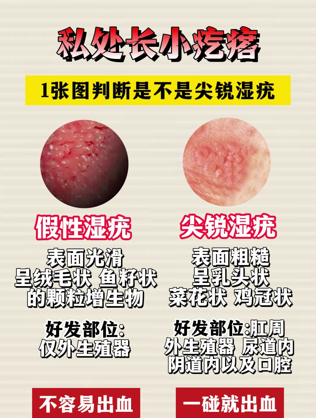 私处长小疙瘩,1张图判断是不是尖锐湿疣