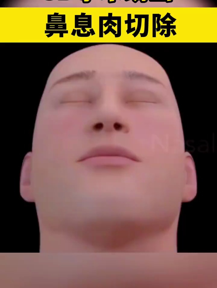 鼻涕多、鼻塞而张口呼吸、都会是鼻息肉的早期症状