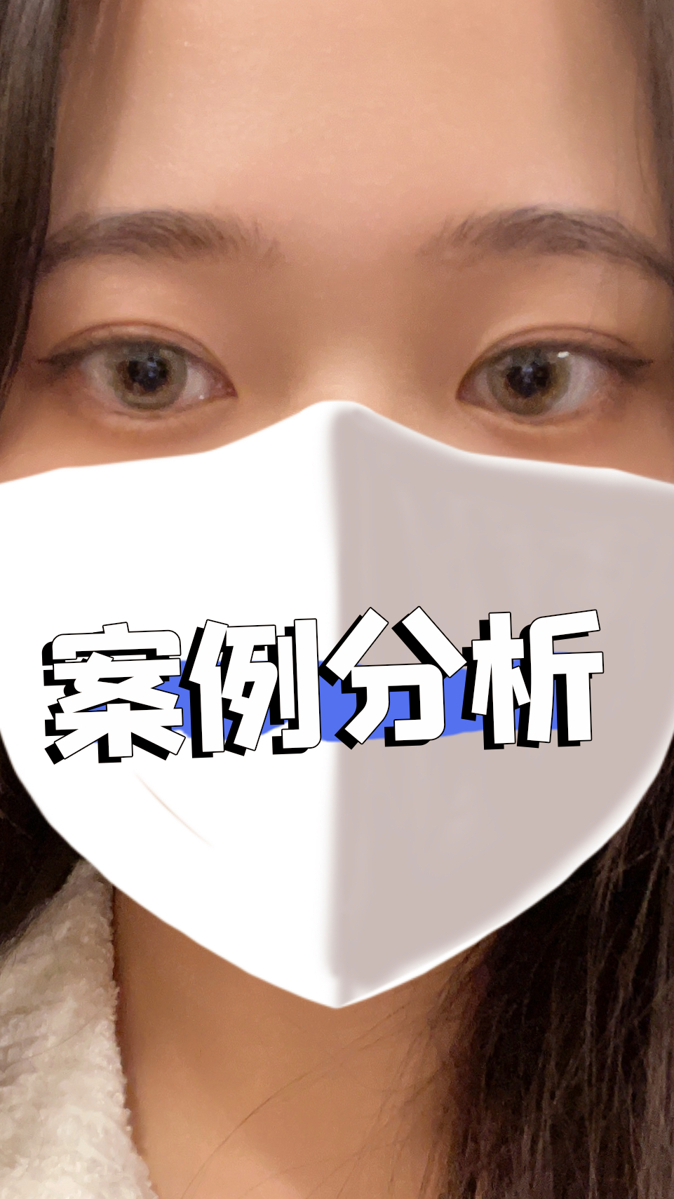 双眼皮埋线不是适合所有人!肿泡眼比较严重的话,还是全切吧