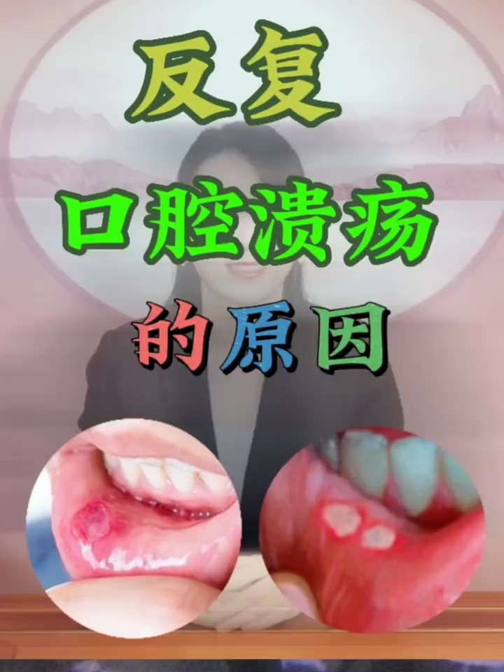 反复口腔溃疡的原因及调理方法口腔溃疡患者看过来