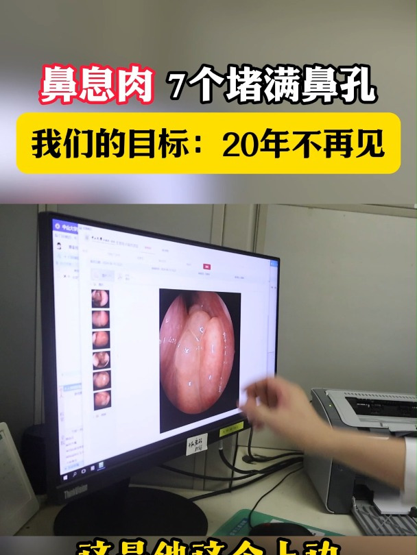 鼻息肉堵满鼻孔怎么办?