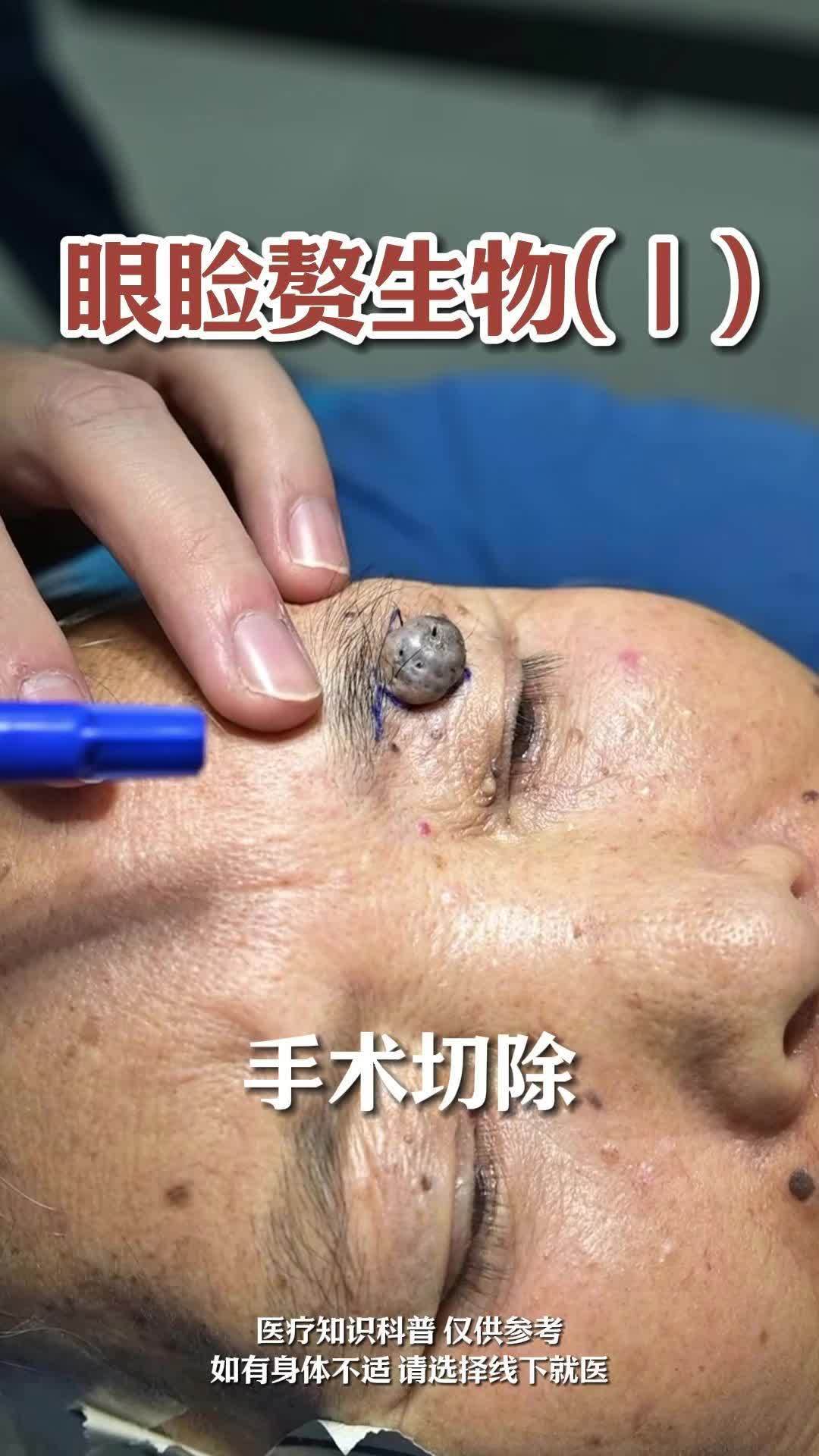 眼睑赘生物手术切除(Ⅰ)