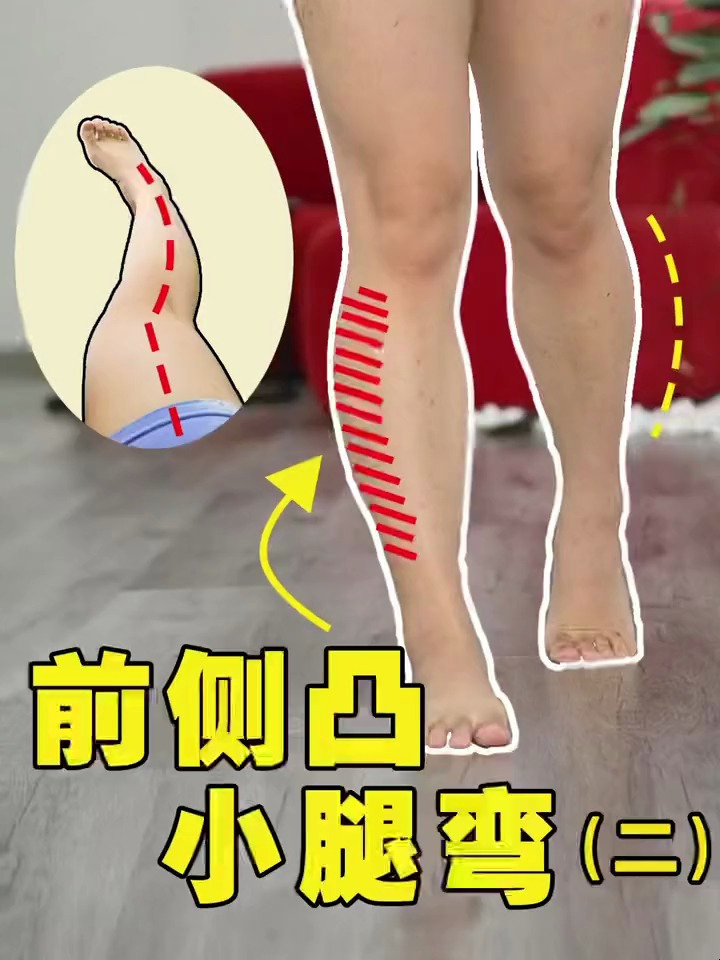 小腿外翻小腿前侧突出僵硬这个视频可以帮到你软化肌肉恢复功能!