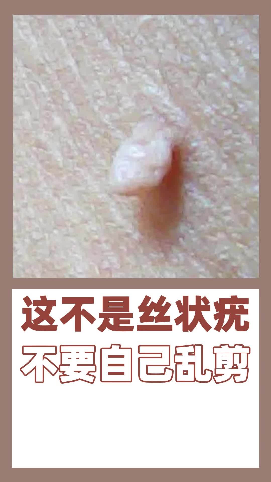 这不是丝状疣,不要自己乱剪