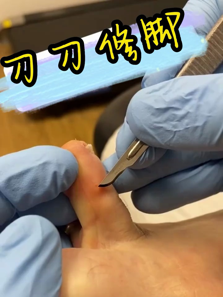 专业修脚,去除脚趾鸡眼老茧死皮,超解压