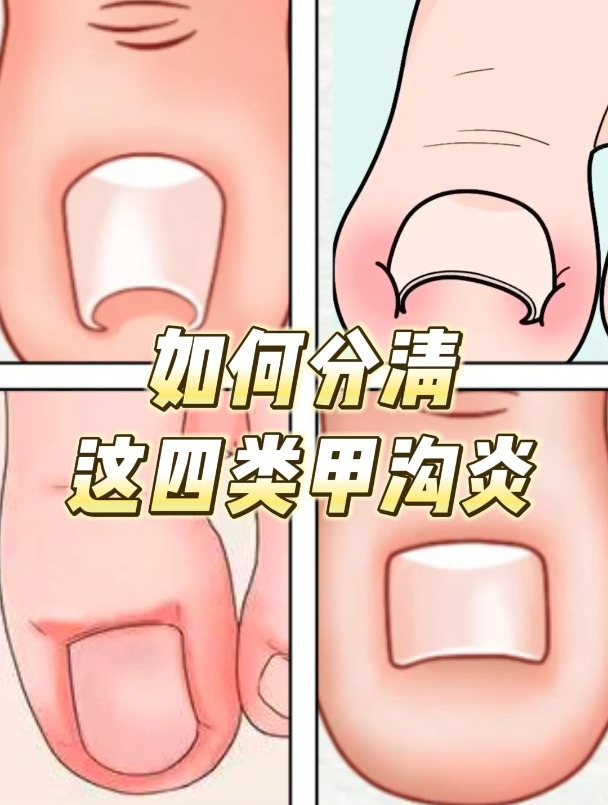 如何分清这四类甲沟炎
