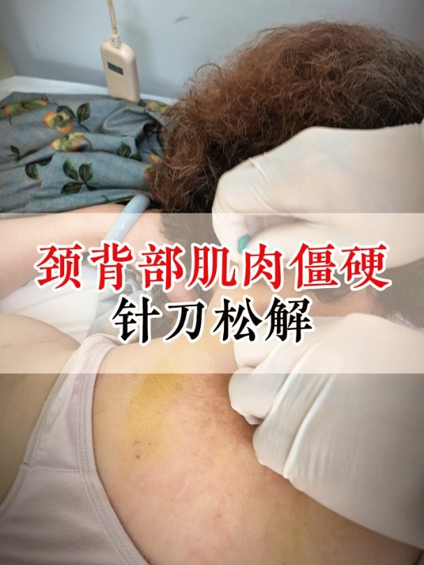 颈背部肌肉僵硬,针刀松解