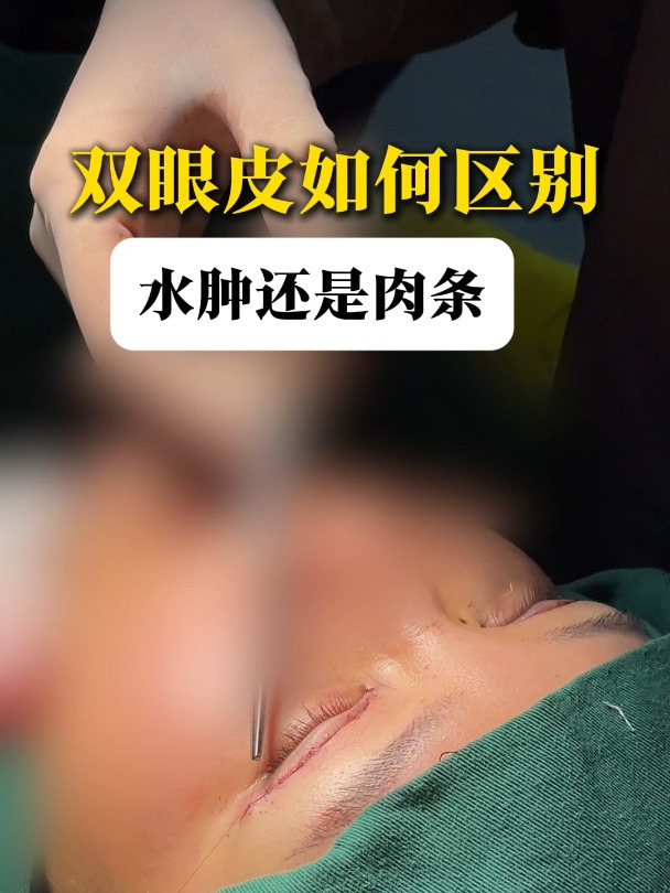 双眼皮术后如何区别水肿还是肉条?