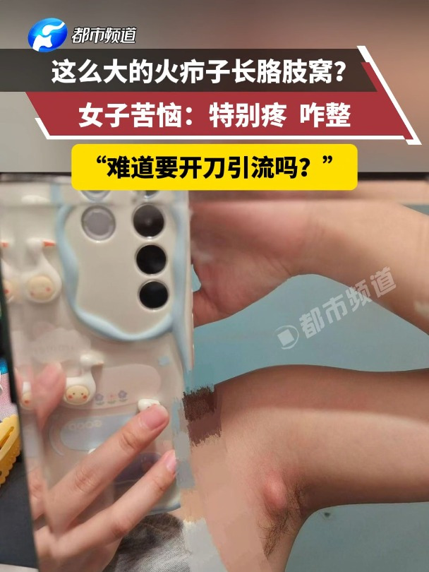 这么大的火疖子长胳肢窝?女子:特别疼 咋整