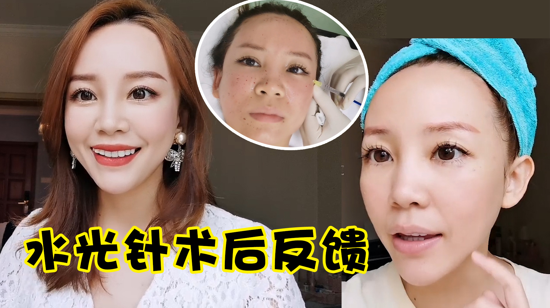 「反馈」术后30天,3000的水光比300的贵在哪?成分作用小科普
