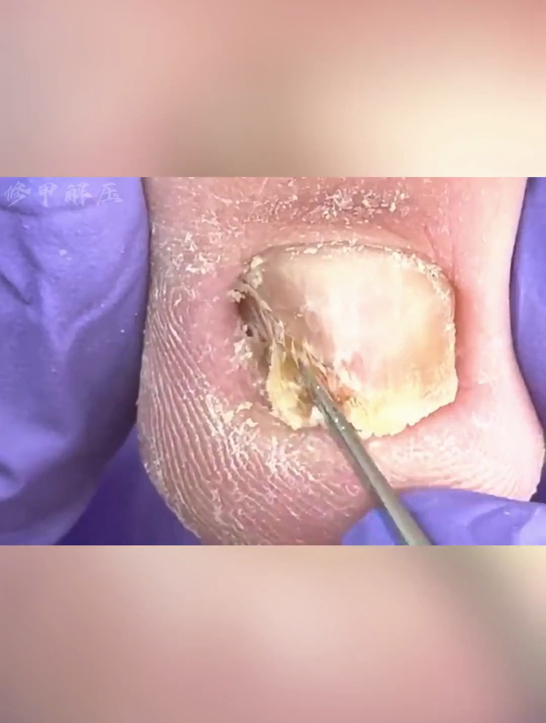 增厚变硬的指甲,修剪后留下两个深深肉坑。修指甲