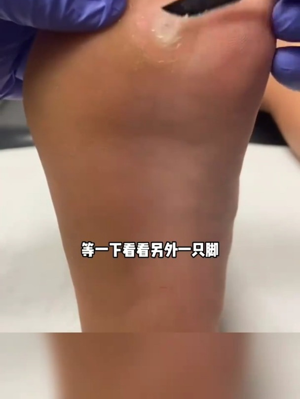 从来没见过这么大的鸡眼!