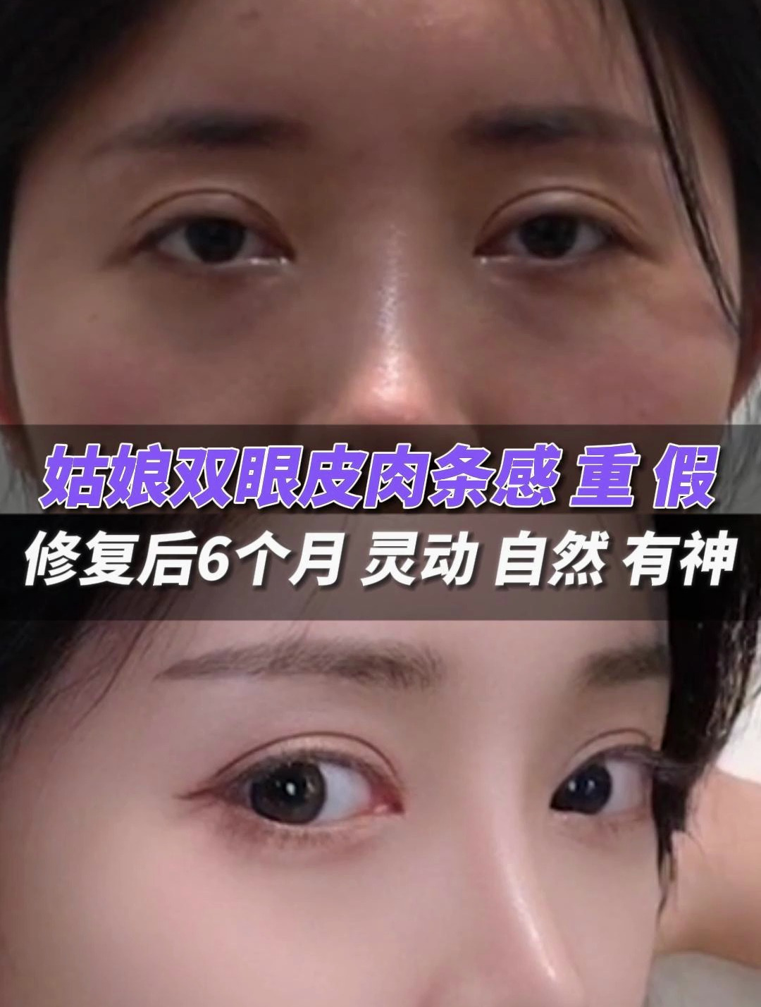 28岁姑娘双眼皮假、肉条感重修复后6个月,灵动、自然又传神