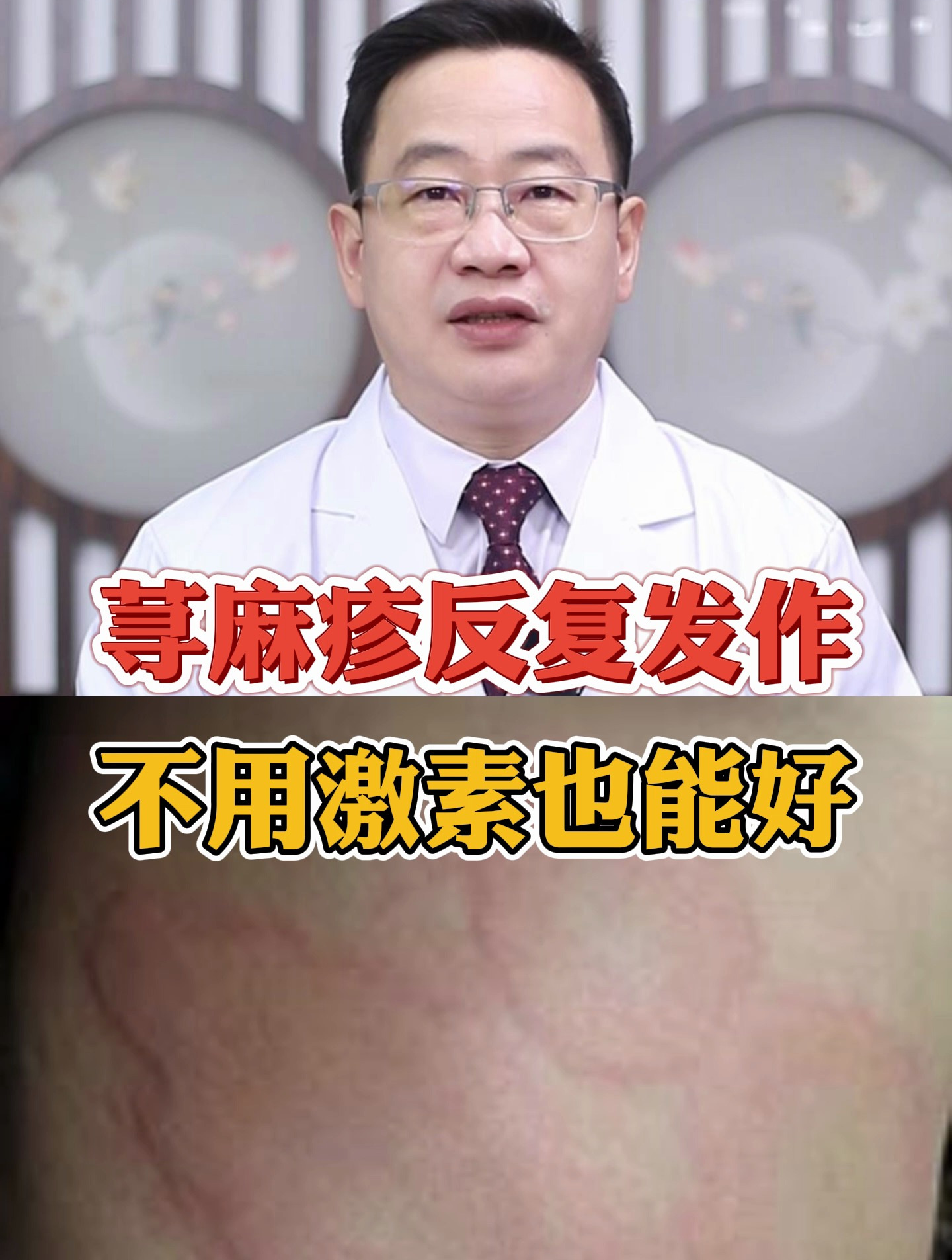 荨麻疹,不用激素也能好