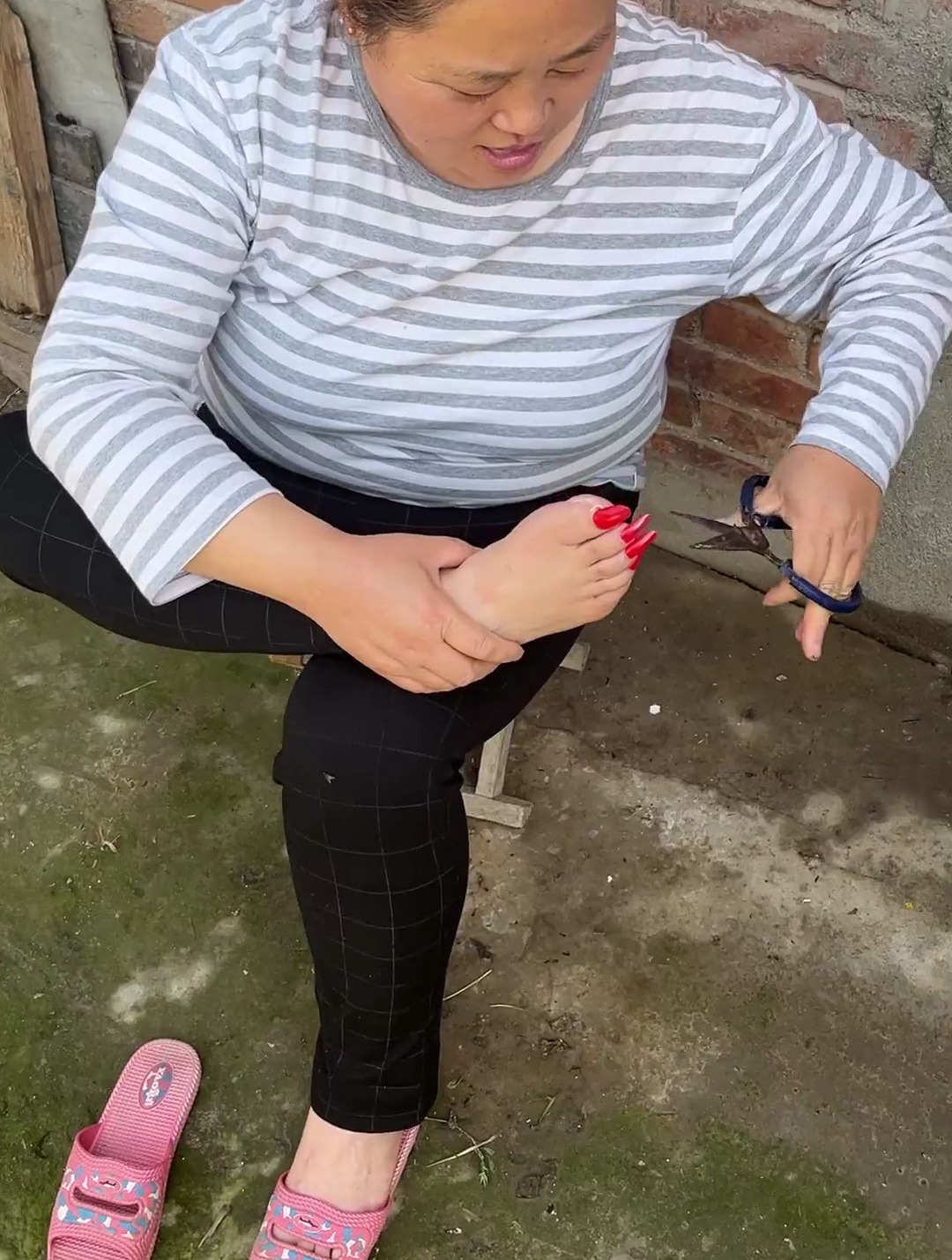 指甲总往肉里长,上海研发“除痛夹”,烂指甲息肉一剪就除