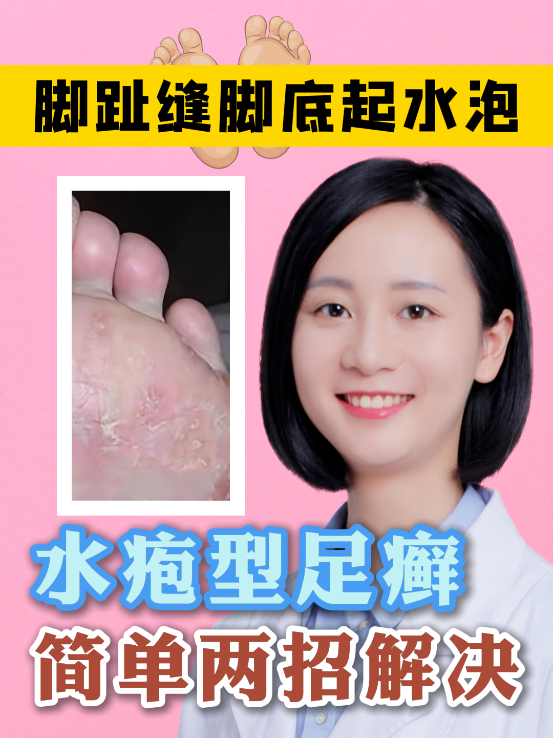 脚趾缝脚底起水泡 水疱型足癣简单两招解决