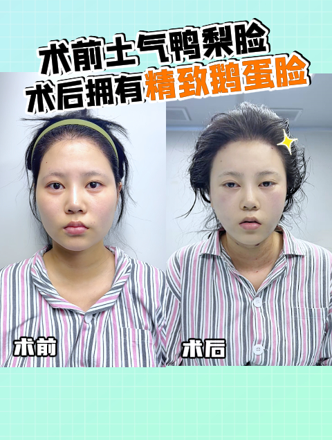 术前土鸭梨脸,术后精致鹅蛋脸!只是找吴院改善了脸型,值不值!