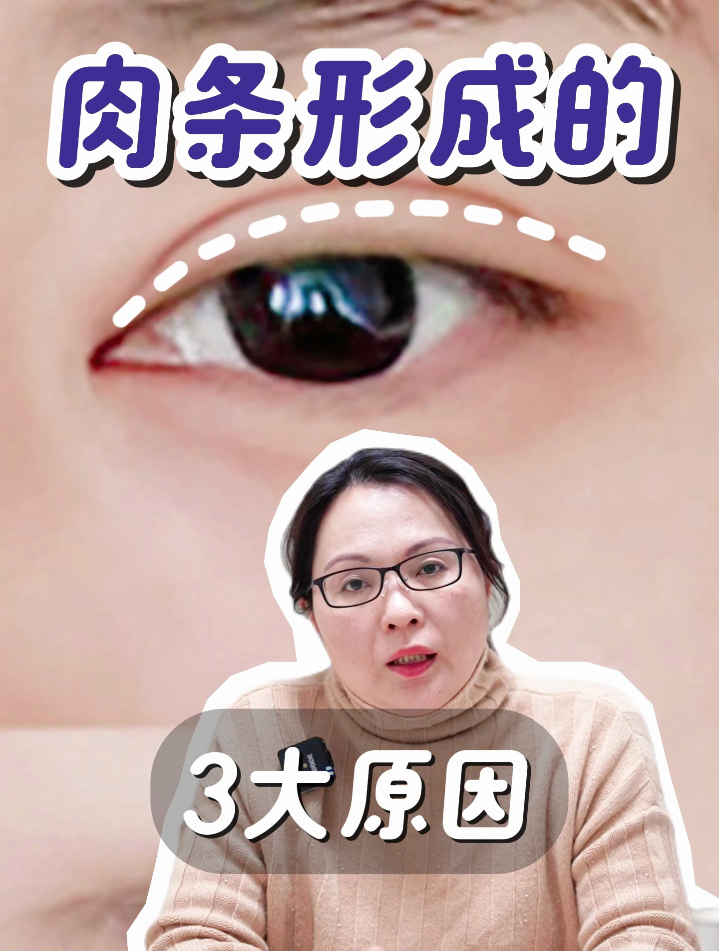 双眼皮肉条感的3大原因