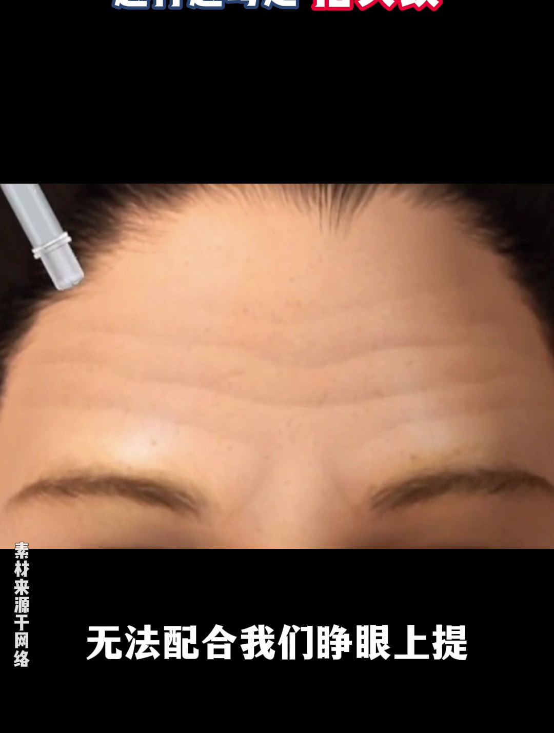 打完肉毒素的副作用,你都出现过吗?