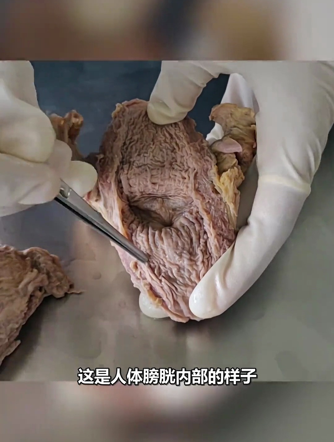 这是人体膀胱内部的样子