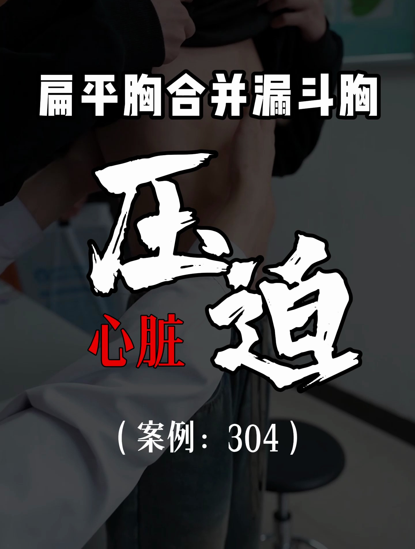 漏斗胸鸡胸医生张东升