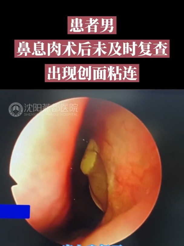 鼻息肉手术要及时复查