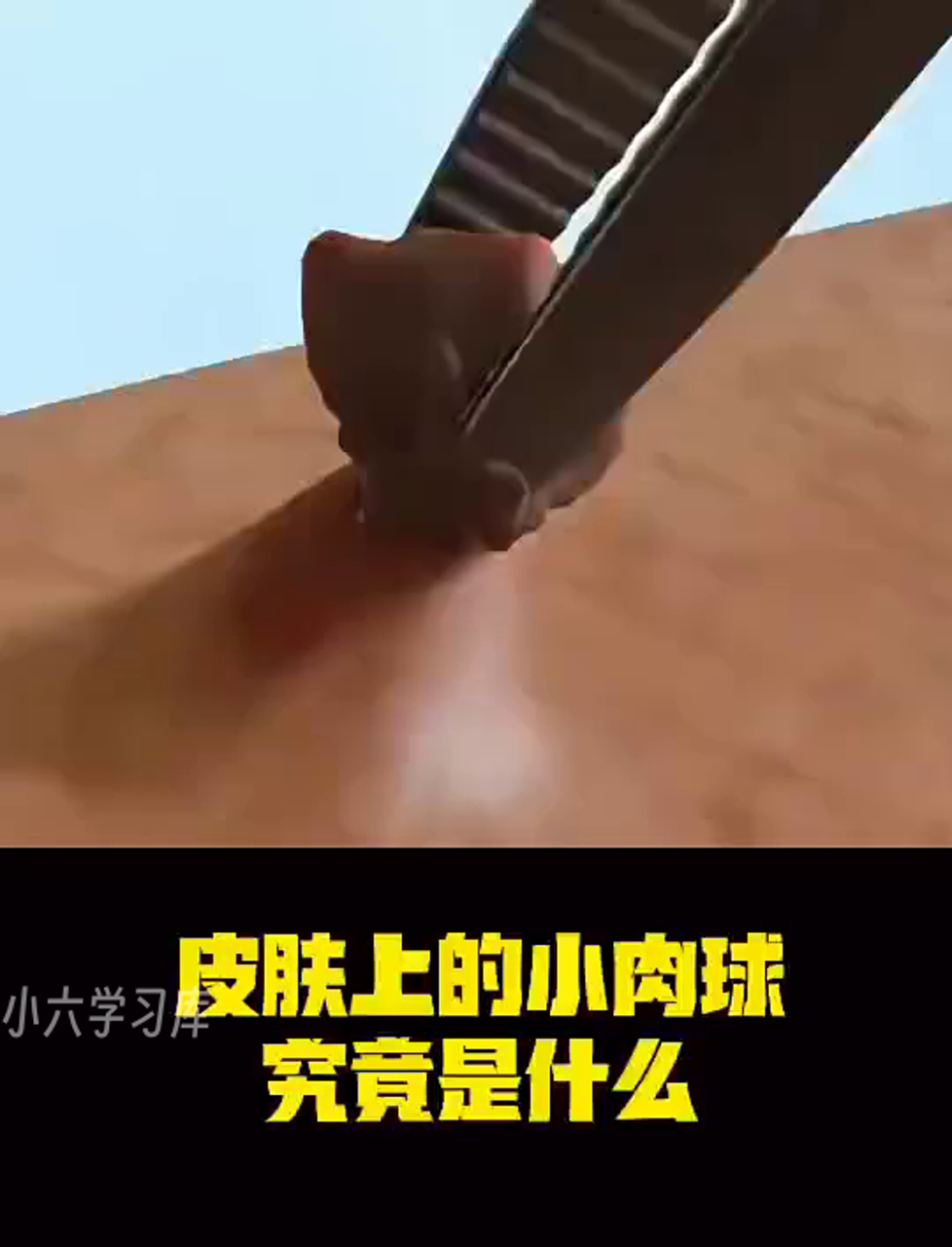 身上长的小疙瘩是啥玩意儿?咋整掉它?