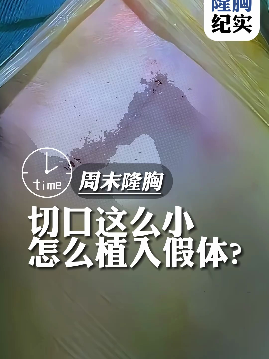 腋下切口这么小,假体隆胸是怎么植入体内的?