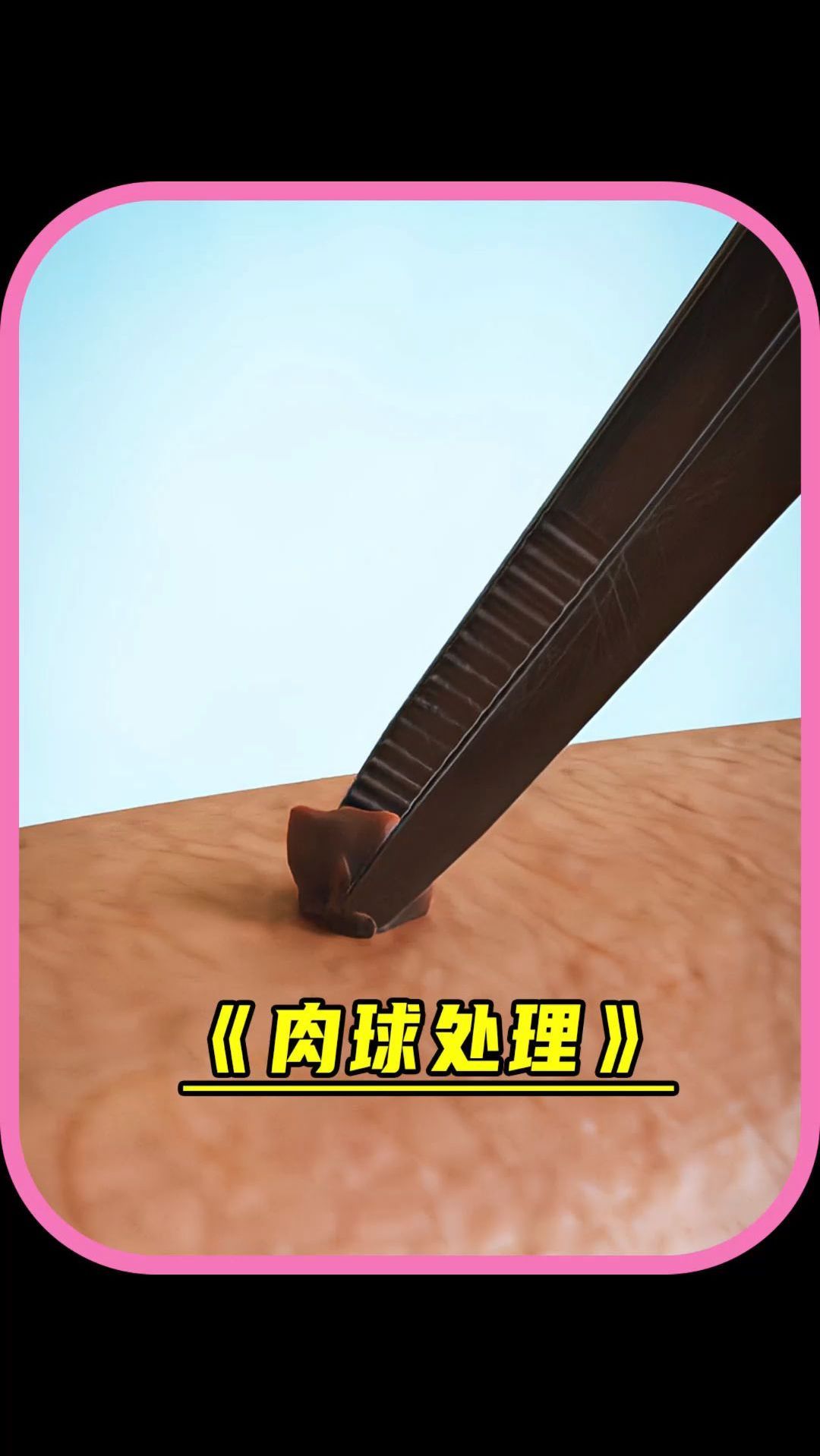 皮肤上的肉球该怎么处理