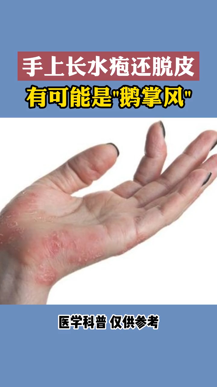 手上长水疱还脱皮是怎么回事?
