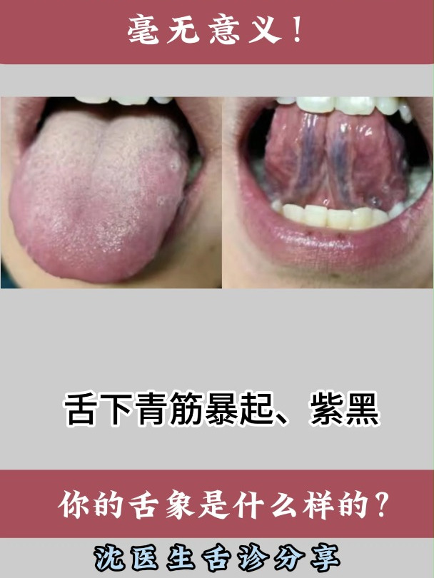 舌下青筋暴起、紫黑,若单活血化瘀,只会浪费金钱时间,毫无意义
