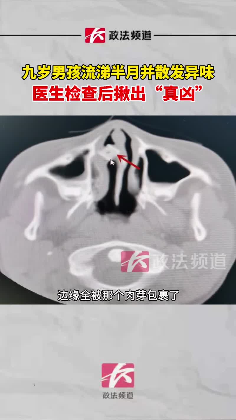长沙九岁男孩流涕半月并散发异味,医生检查后揪出“真凶” 儿童安全