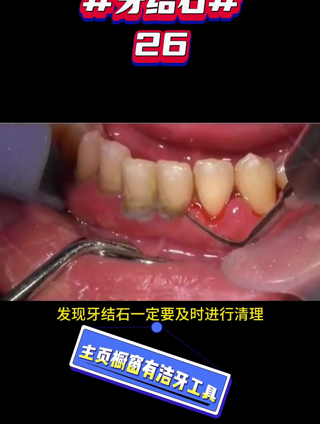 牙结石真的要尽早处理,牙龈萎缩它“功不可没” 牙结石 解压视频