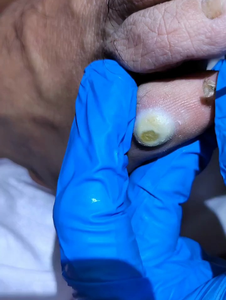 强迫症必看解压视频 小伙脚趾外侧长了个鸡眼 看完很解压!