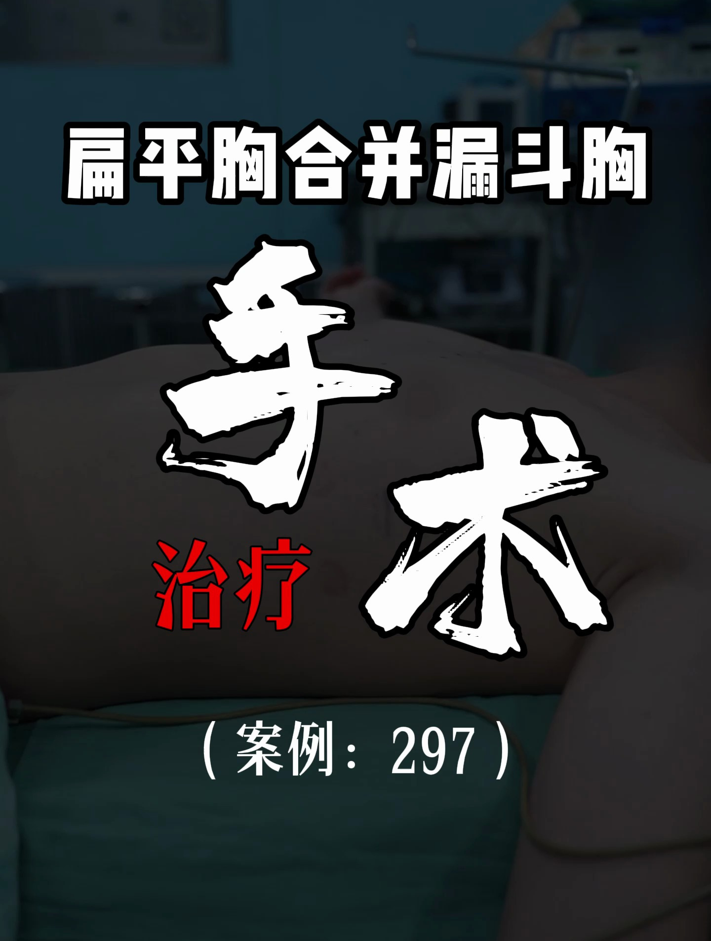 漏斗胸鸡胸医生张东升