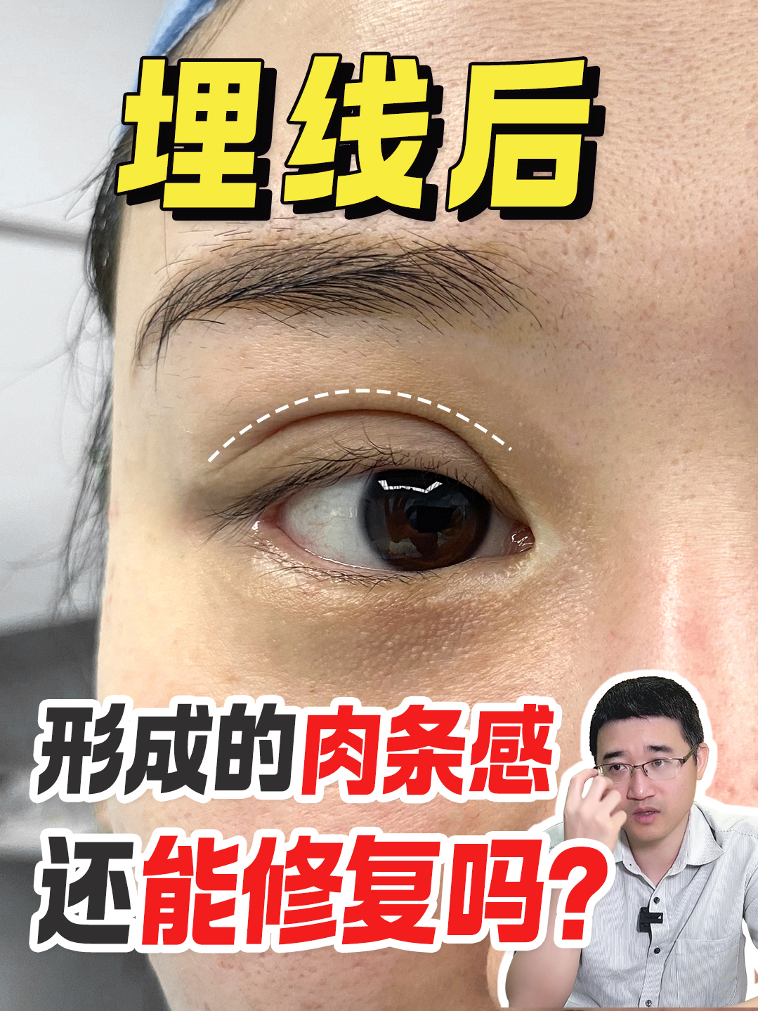 双眼皮埋线形成的肉条感能修复吗?