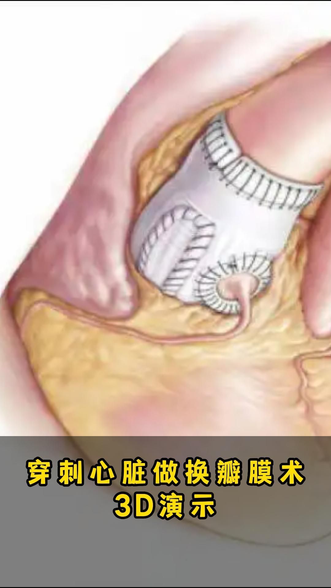 穿刺心脏做换瓣膜手术3D演示