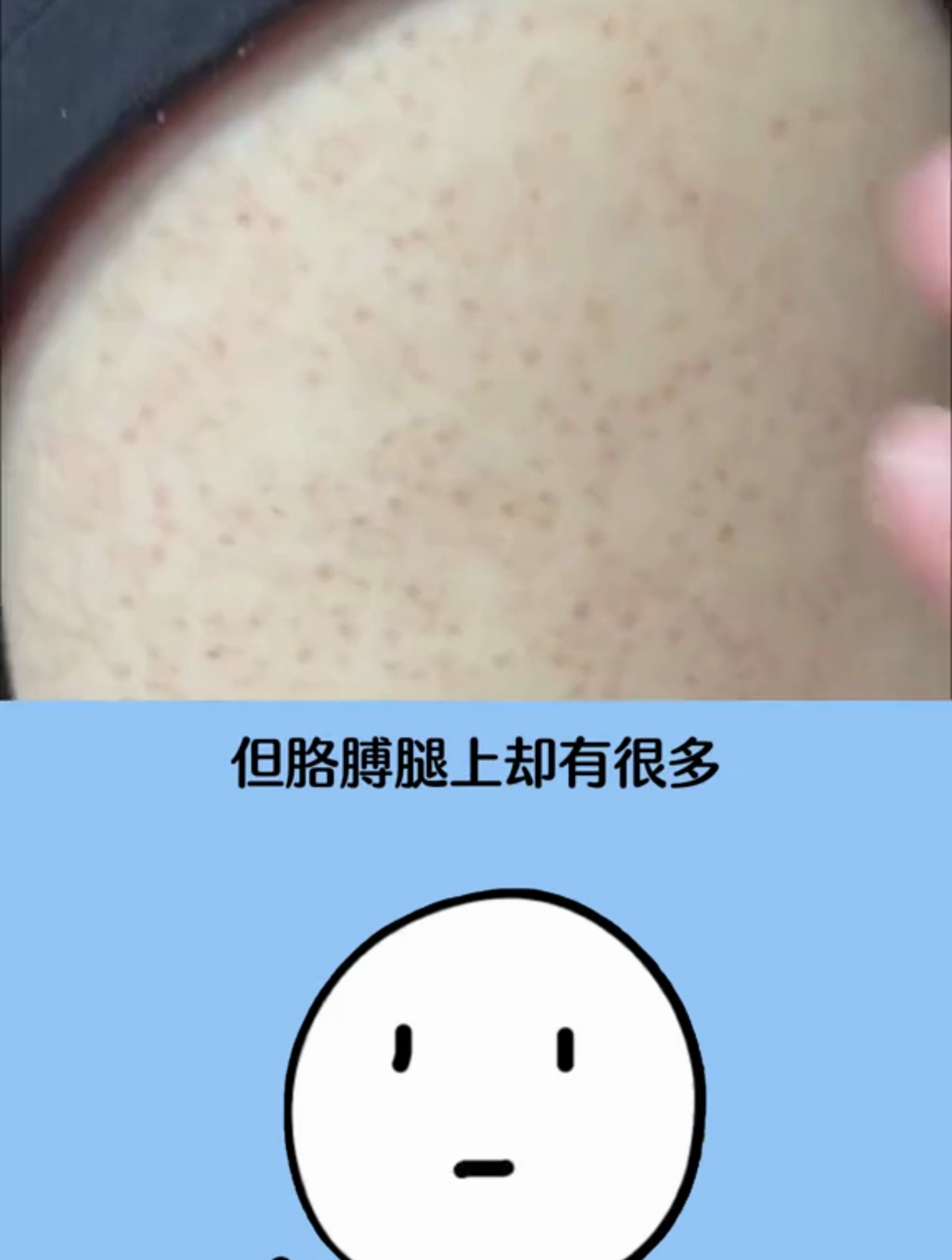 商夏天的较量快开始了你还在被鸡皮肤困扰吗