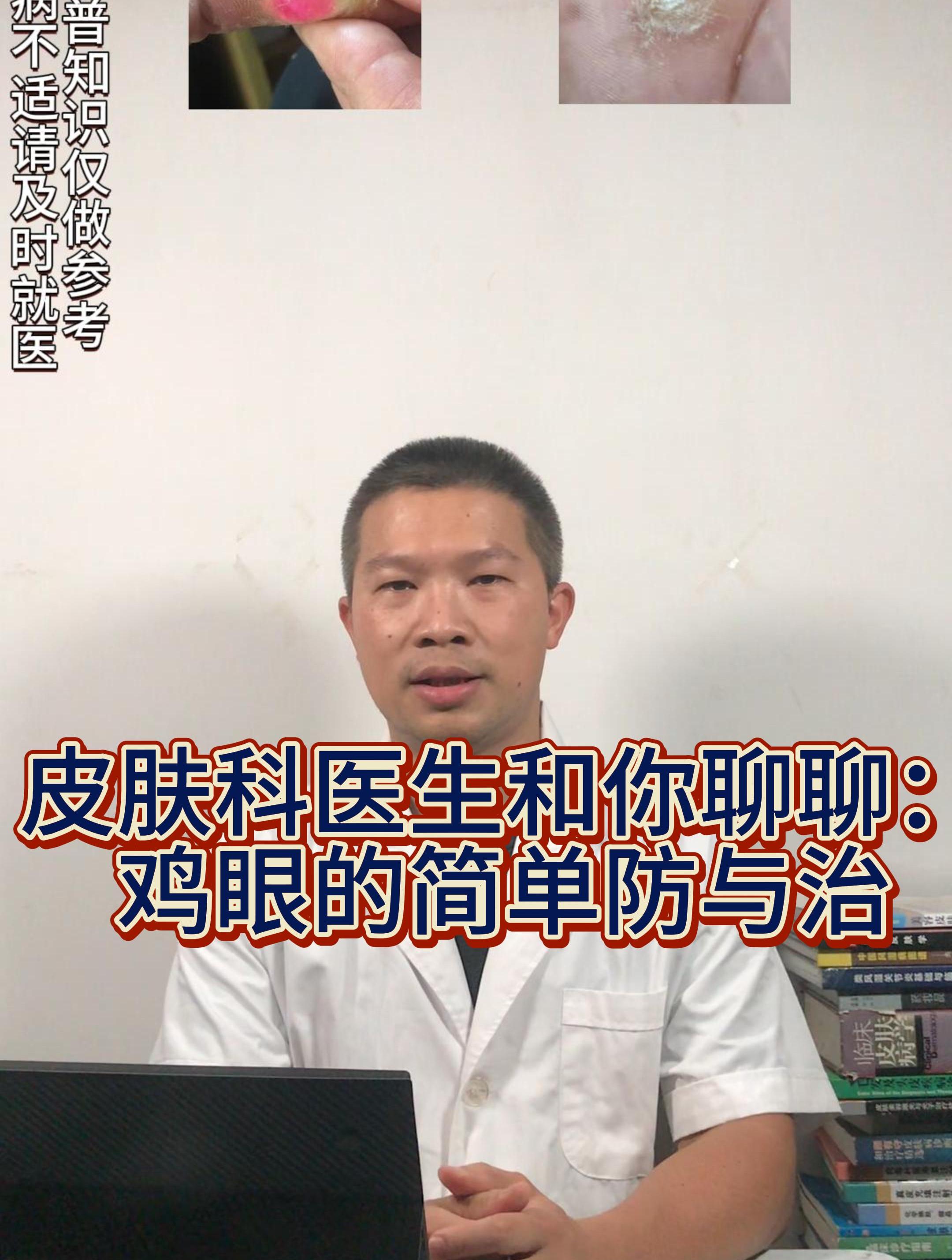 皮肤科医生和你聊聊:鸡眼的简单防与治