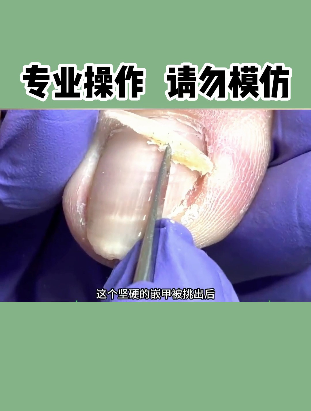 指甲长到肉里的痛苦,女朋友说再也不想体验了,修剪过程很是解压